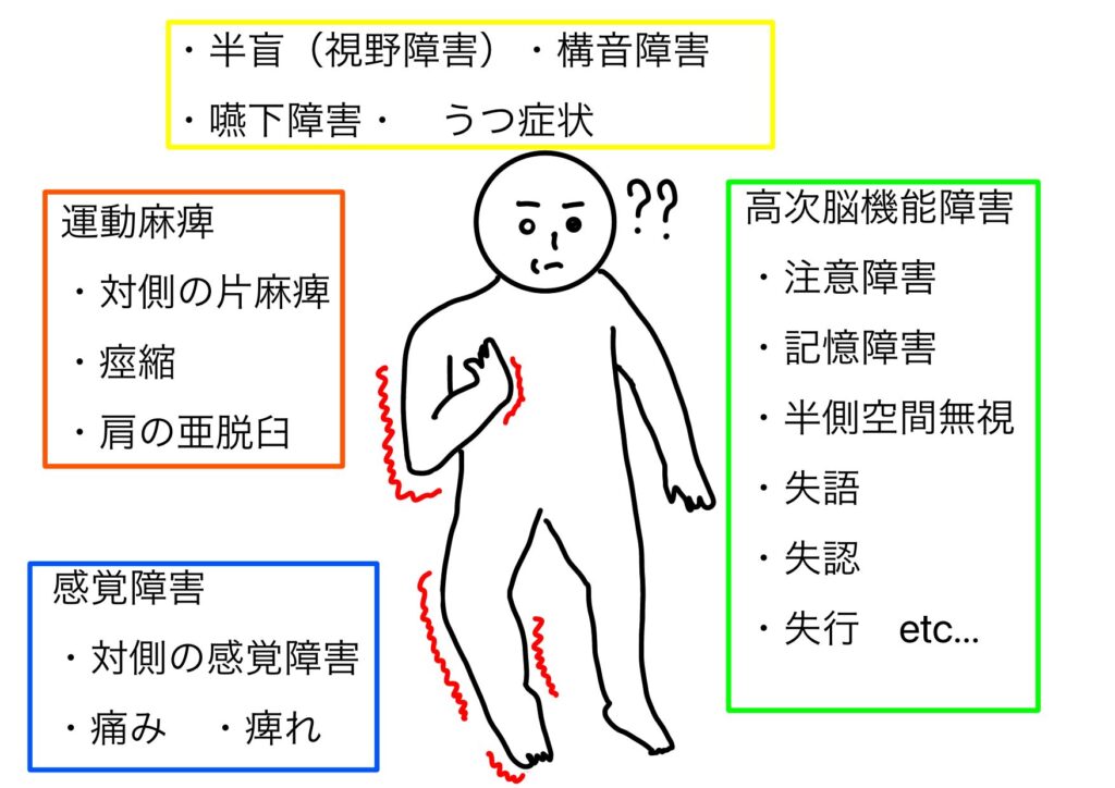 脳卒中の症状