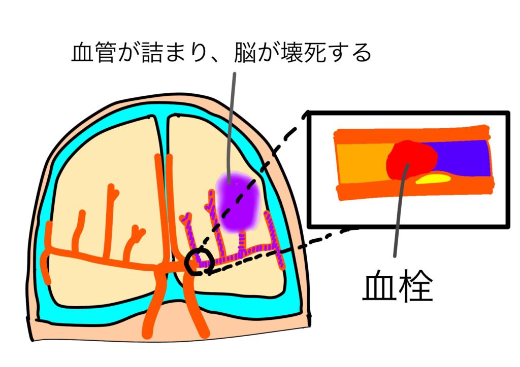 脳梗塞リハビリ