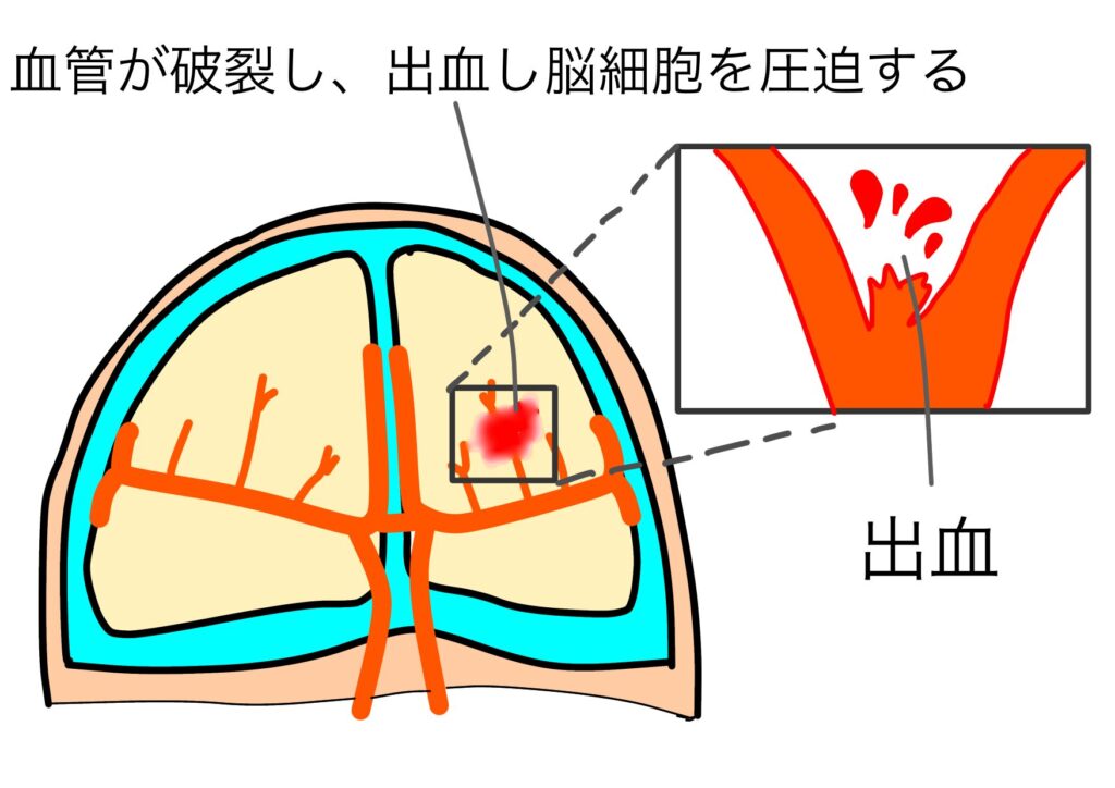 脳出血リハビリ